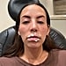 I Got My Lip Filler Dissolved: See Photos