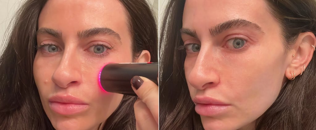 I Tried the Lyma Laser: See Photos