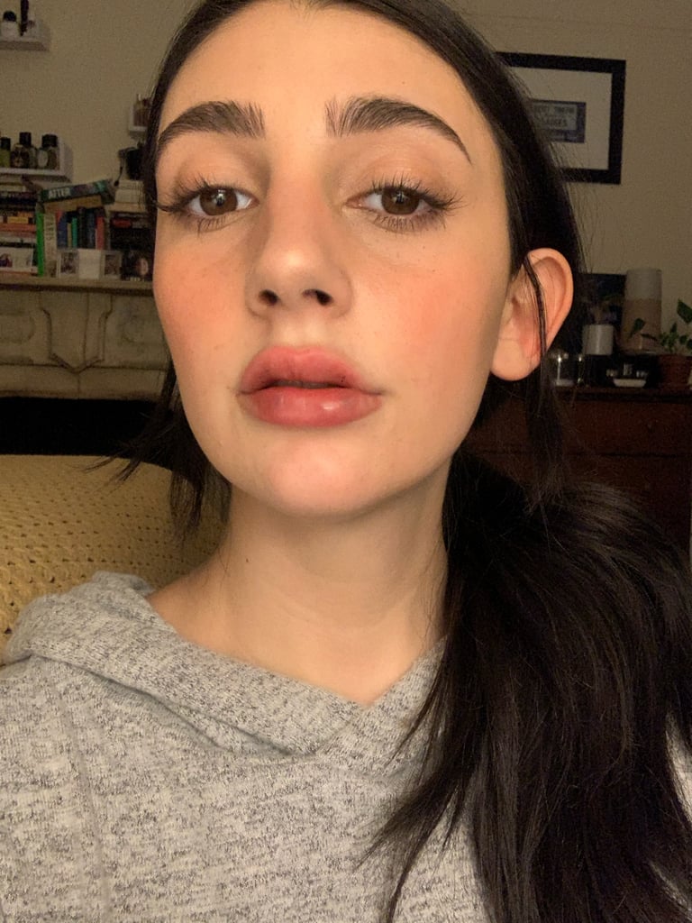 After Second Round Of Lip Injections I Got Lip Filler See The Before 