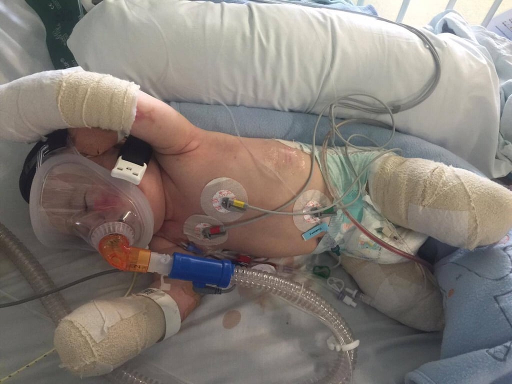 Boy With Amputations From Meningitis Takes First Steps
