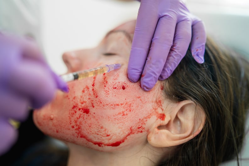 Close-up photo of doctor applying blood plasma during PRP vampire facelift.