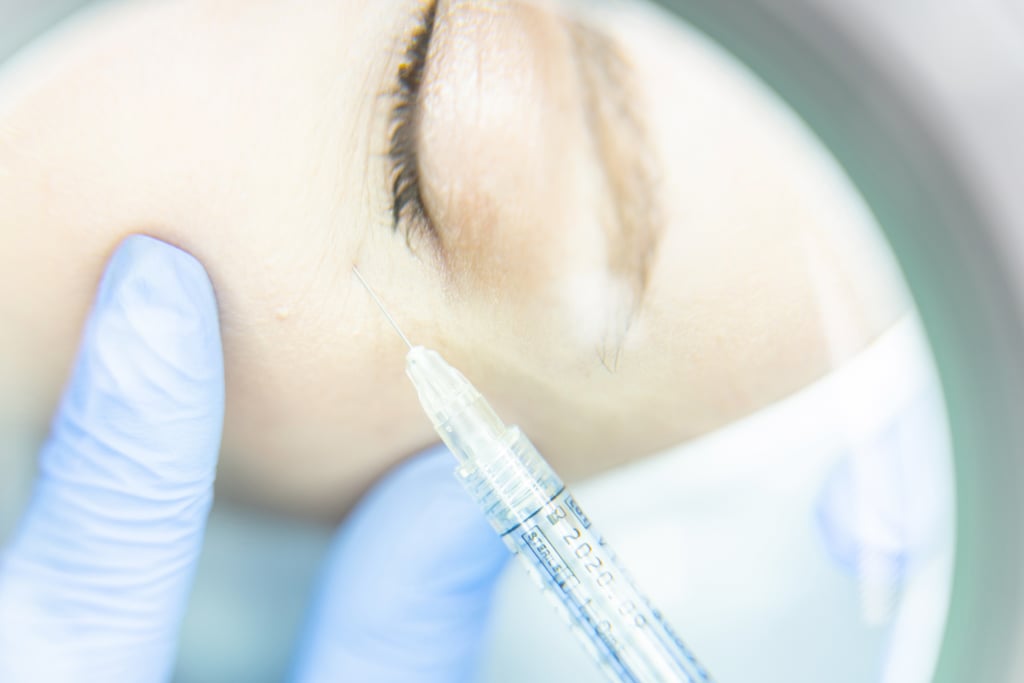 When Will You Notice Results From Filler?
Fillers also take a minute to "settle" — basically where they're actually going to sit on your face long-term. They can also feel a little lumpy under your skin, but the fillers will smooth out on their own. Settling can take anywhere from one day to two weeks, says Dr. Marmur. No matter what, you should schedule a follow-up for two weeks after your treatment so your doctor can make sure everything is looking perfect. 
How Long Do Undereye Fillers Last?
Unlike lip filler, which lasts about six months, the effects of treating your undereye area lasts much longer. "That's one of the best, most gratifying things about fillers under the eyes," says Dr. Marmur. "It lasts a very long time — sometimes for years and years." Because the undereyes aren't a very highly trafficked area of the face (as opposed to the lips, for example), it takes longer for the body to gradually absorb the hyaluronic acid particles. Usually undereye fillers last around a year.
Can You Dissolve Undereye Filler?
Yes. If for some reason you don't like the look of your undereye filler, your doctor can inject hyaluronidase and within 48 hours the filler will dissolve.
What Should You Look For in a Doctor?
You should make sure you're going to a board-certified dermatologist or board-certified facial plastic surgeon. This isn't the time to use your Groupon or go to a MedSpa. "The doctor shouldn't be pushy," says Dr. Marmur. "It should be somebody who you feel is not a salesperson, and who is really there because they love the art of doing this. Also, somebody who likes the 'less is more' approach. You need to get a sense that you trust that they'll take care of you if something goes wrong and that they can talk to you from experience."
Dr. Marmur says she thinks it's a good thing that procedures like dermal fillers and Botox are more readily available, but you should still treat it in the same way as any other medical procedure — in other words: go to a doctor's office not a mall kiosk. 
"There's a lot of trust transfer going on here," she says. "It might seem like we're in this new age where a lot of the mystique has fallen from doing fillers and Botox. I'm happy because it allows people to ask questions. There's nothing vain about it, it's self-care, and it's healthcare as well. You have to understand you're taking a leap of faith and that you really need to feel like that person is legit."