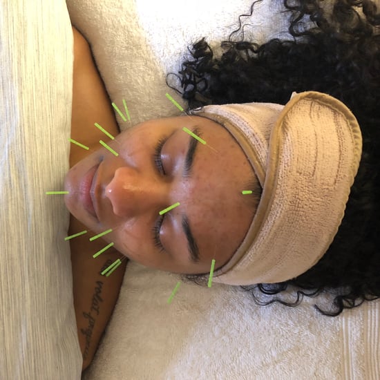 Acupuncture For Acne