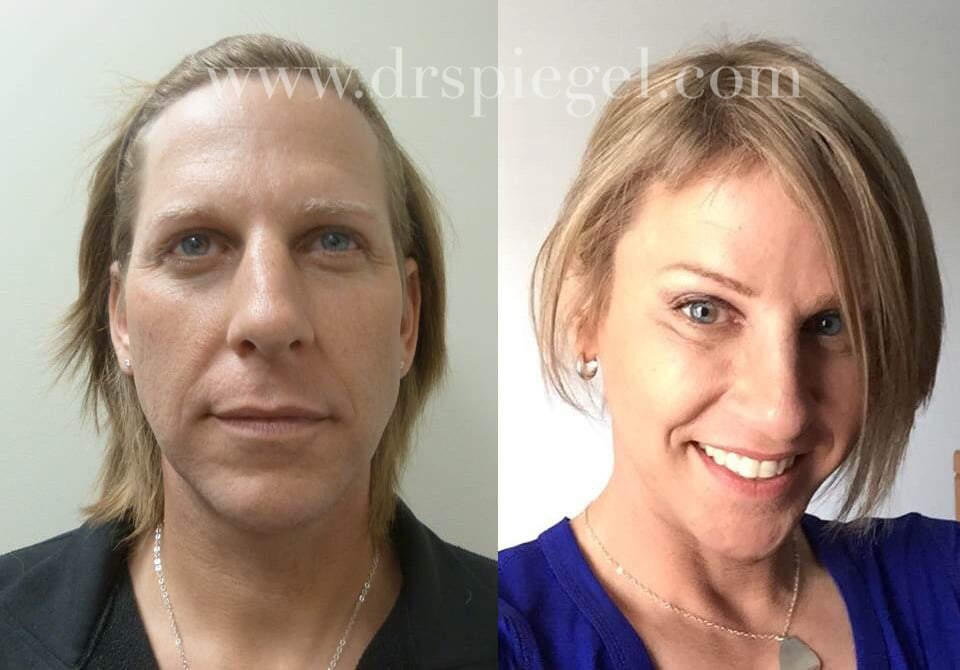 Man On Female Hormones With Sex Change To Girl