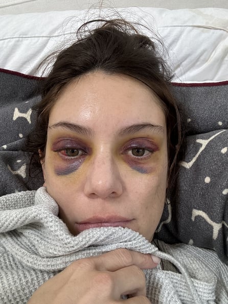 Dark bruising after brow lift surgery