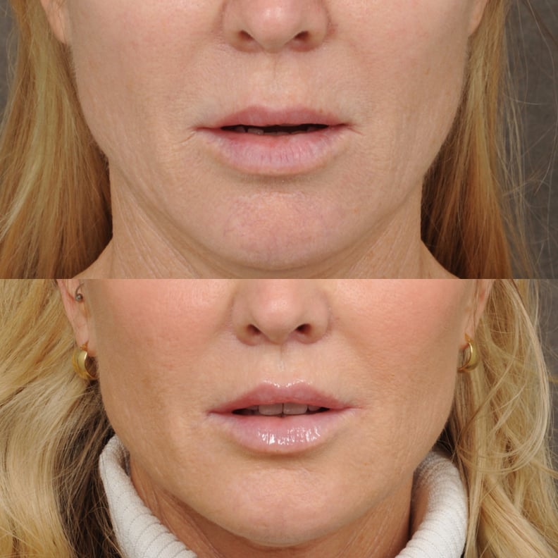 Cupid Lift and PHAT Lips by Dr. Ben Talei