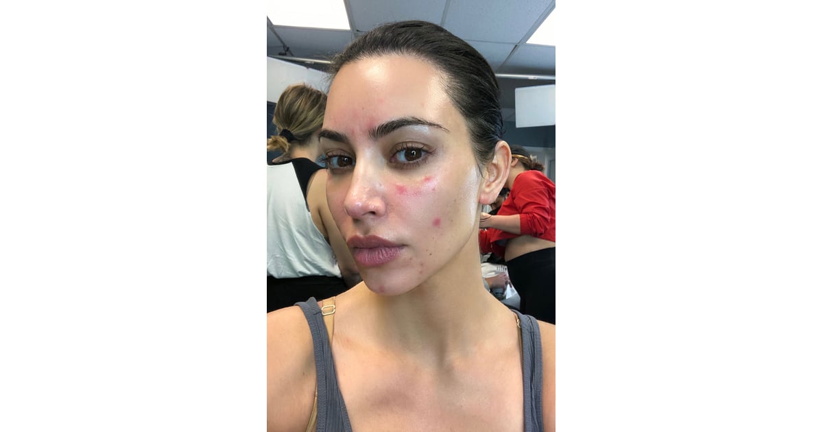 Kim Kardashian Talks About Her Psoriasis With Photos POPSUGAR Beauty