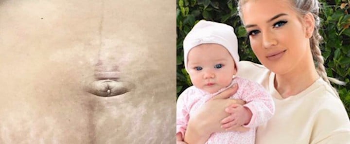 Mom C-Section Photo (Video)