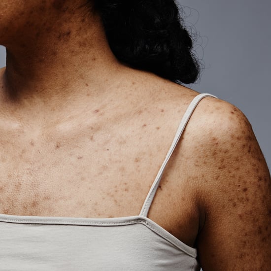 Body Acne Causes and Treatments, According to Dermatologists