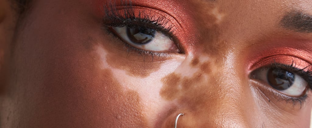Vitiligo Skin Condition Causes and Treatments