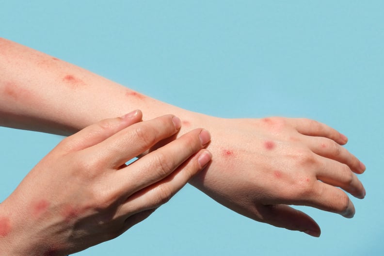 Monkeypox new disease dangerous over the world. Patient with Monkey Pox. Painful rash, red spots blisters on the hand. Close up rash, human hands with Health problem. Banner, copy space. Painful rash, red spots blisters on the hand. Close up Allergy rash,