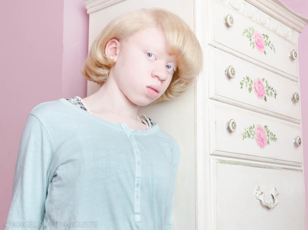 Albinism Photographs Popsugar Beauty Photo 5 