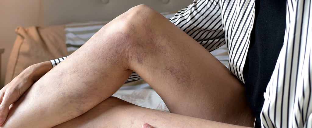 Varicose-Vein Treatments, According to a Doctor