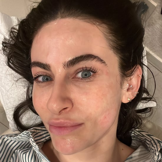 Ultherapy Before and After: Read This Editor's Full Review