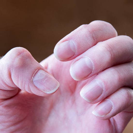 Nail Psoriasis vs. Fungus: Experts Explain the Differences
