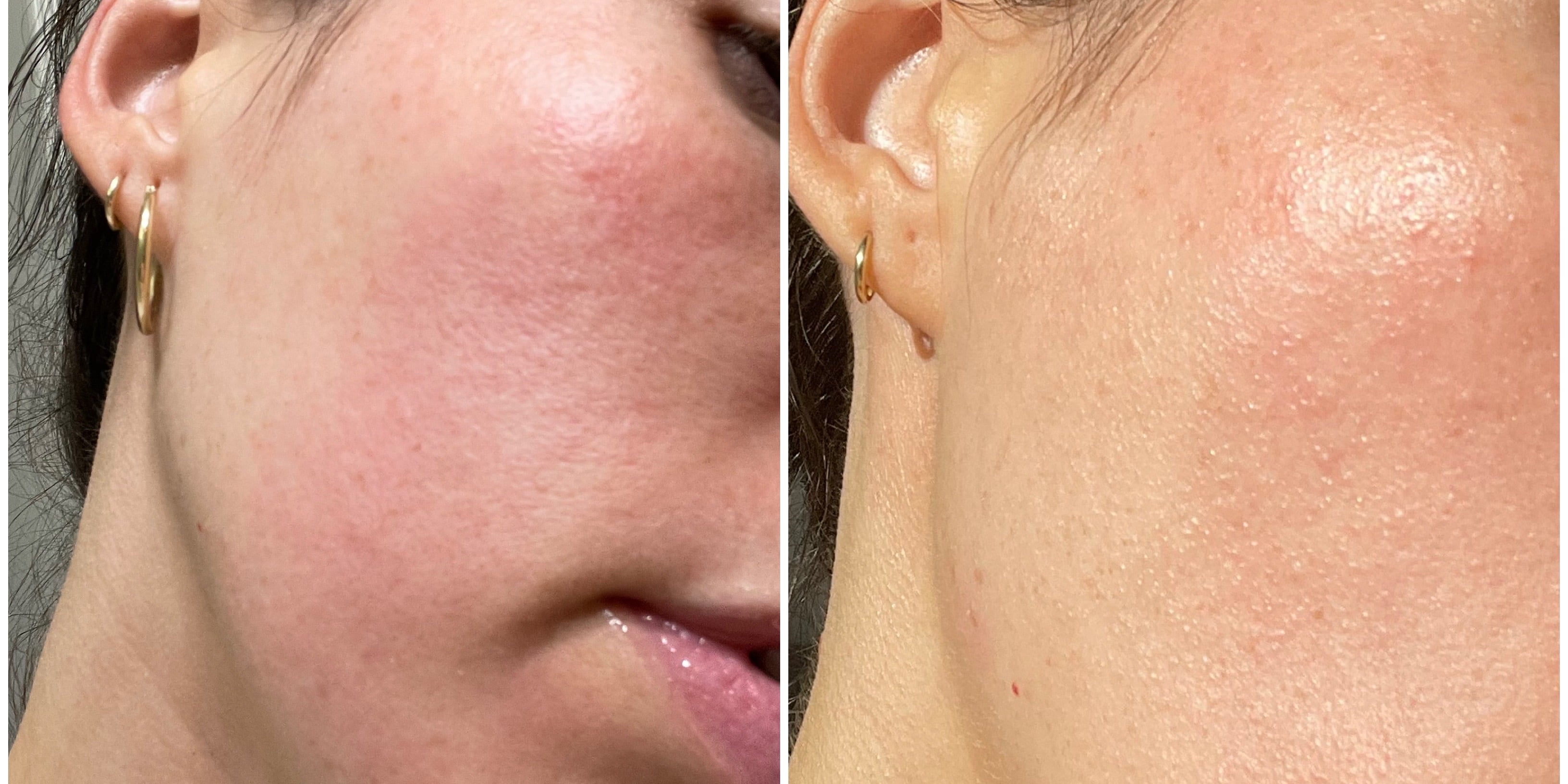 WTF Is Contact Dermatitis? I Asked an Expert For Tips That Actually Work