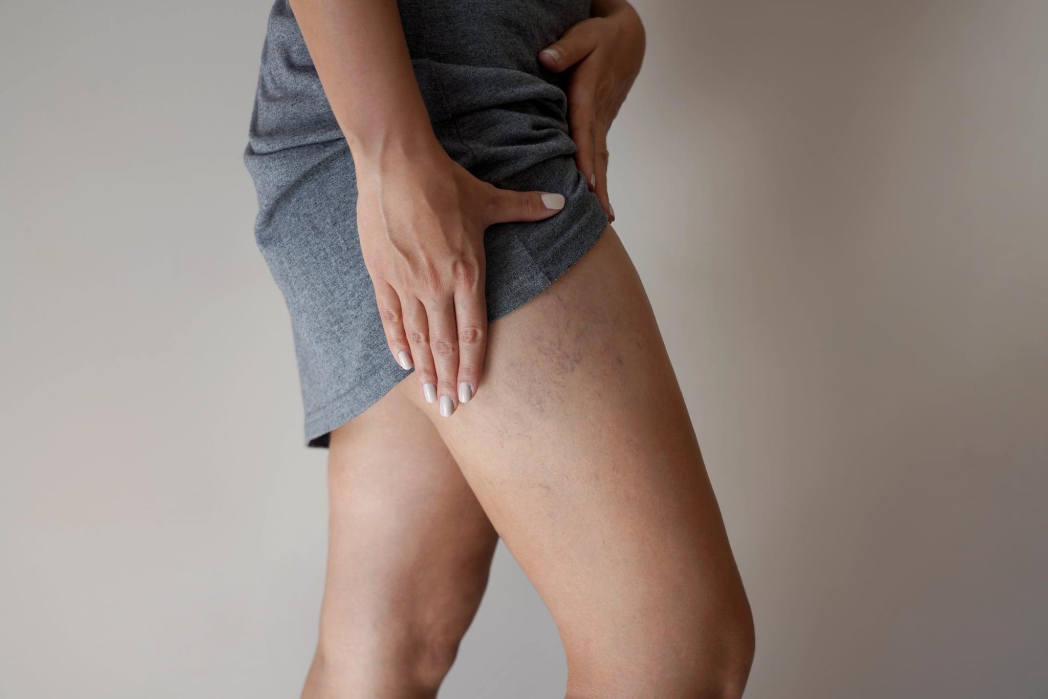 tips for treating spider veins