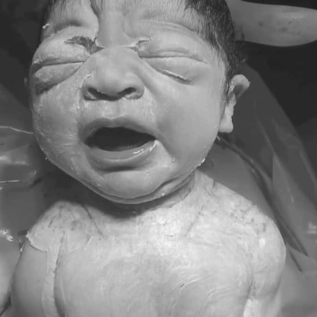 Baby Born Via Gentle C-Section