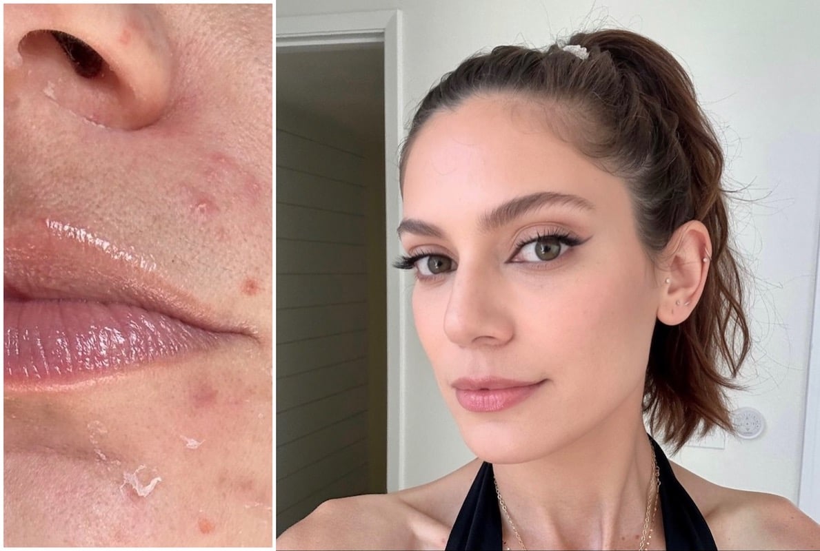 Skin before and after using the Biojuve Living Biome Essentials Duo