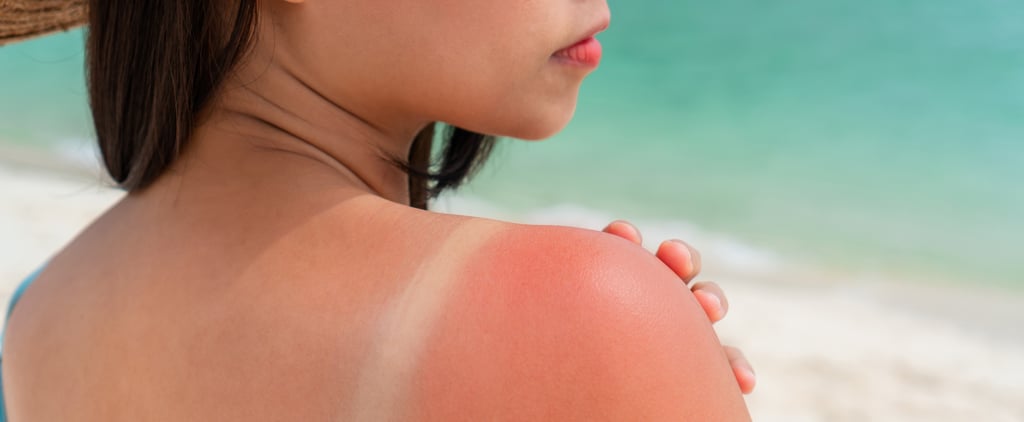 How to Treat and Heal Sunburn Fast