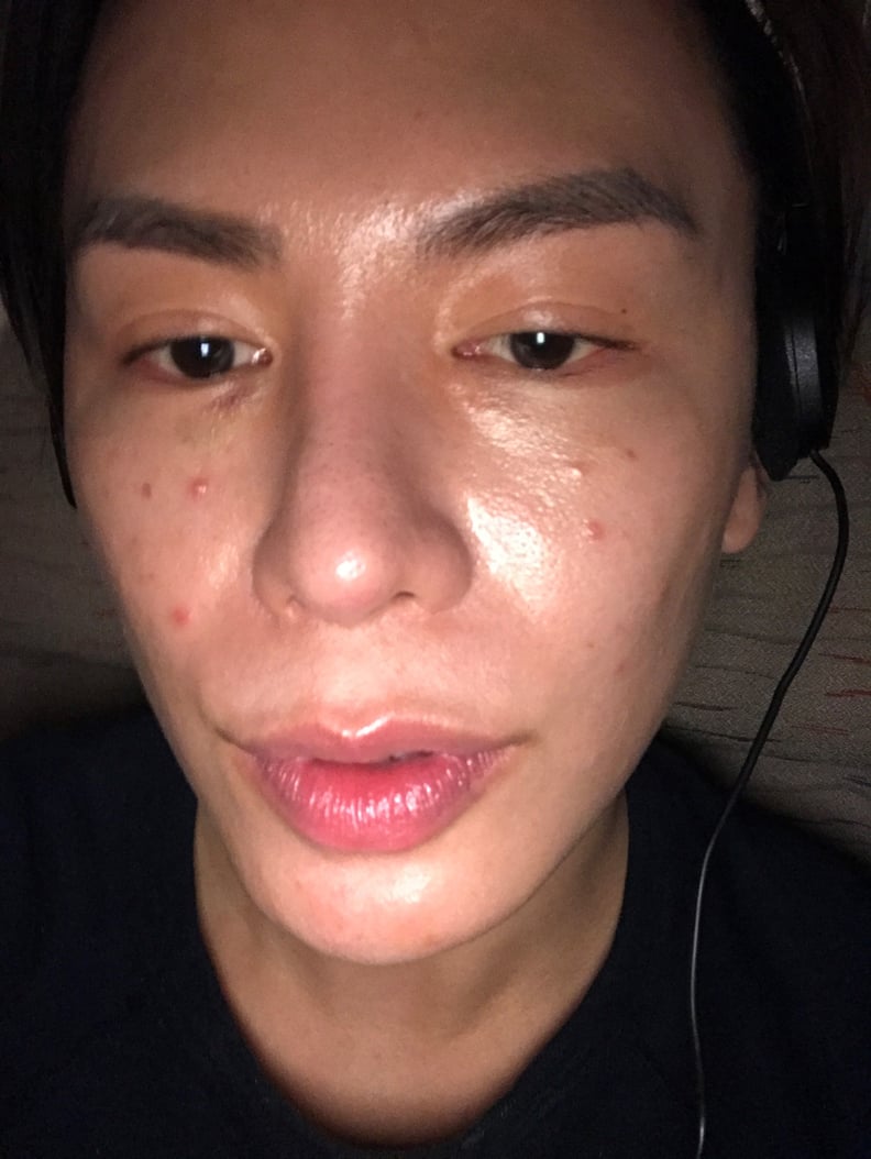 Nicolas Travis after surgery