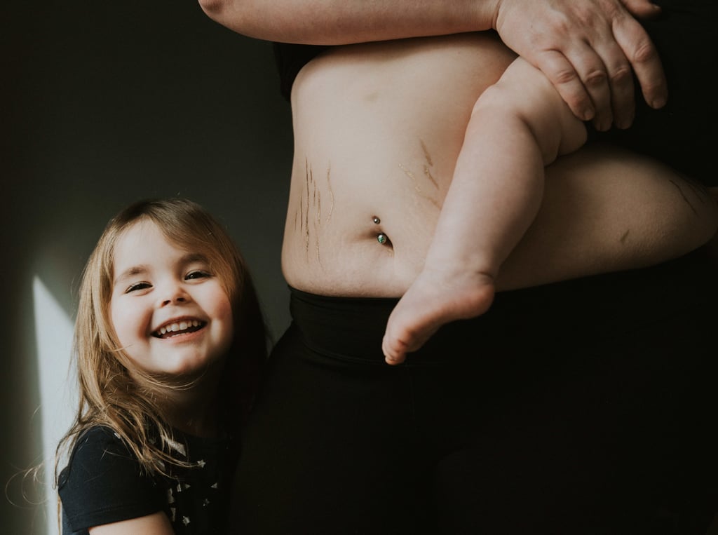 Postpartum Stretch Marks Photos