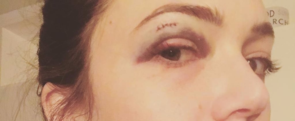 Mandy Moore Black Eye Photo on Instagram
