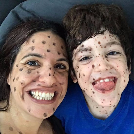 Mom's Message to Strangers Laughing at Her Son's Birthmarks