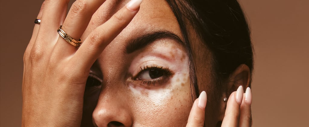 What Is Hypopigmentation?