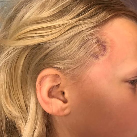 Uncommon Lyme Disease Symptoms