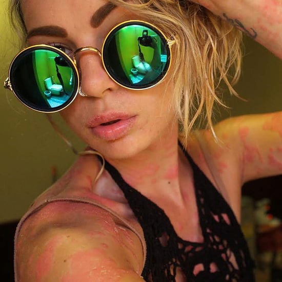 Model With Psoriasis | Psoriasis Pictures