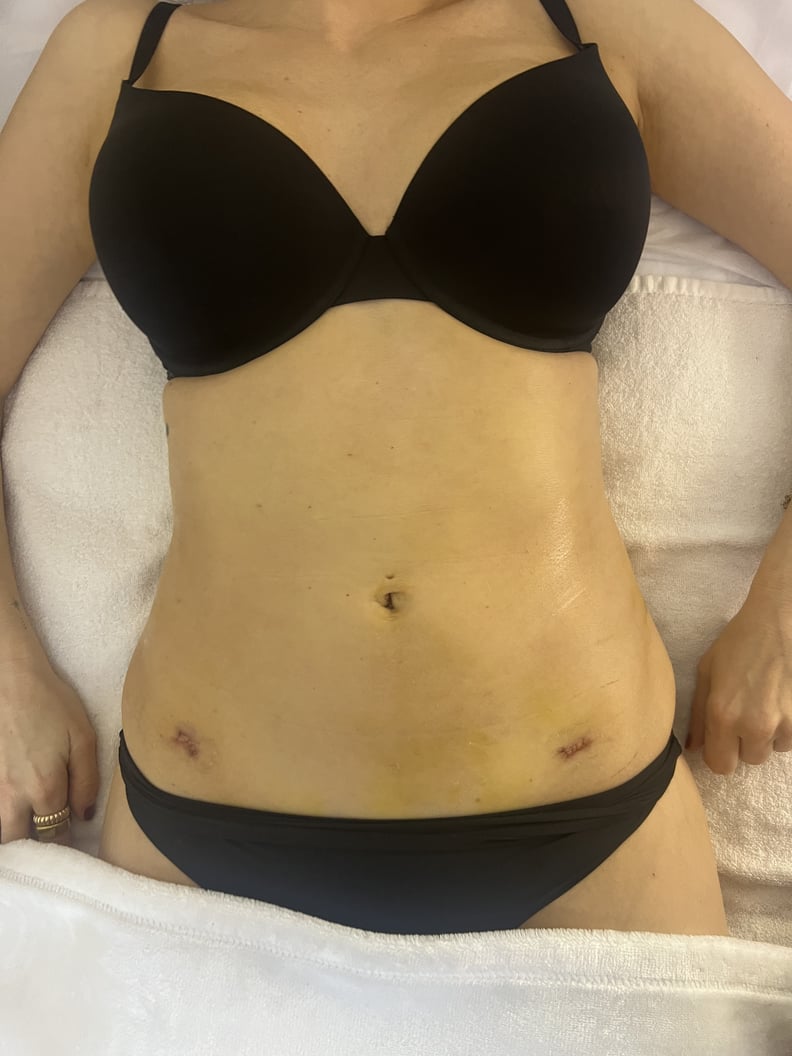 renuvion before and after and review