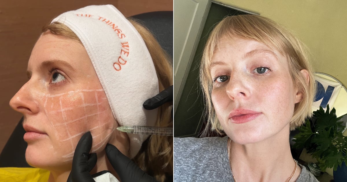 Skinvive Review: I Tried the Injectable Filler | See Photos