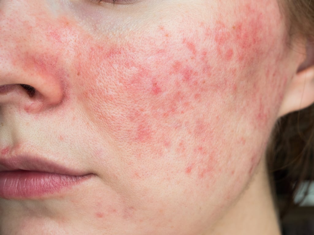 Rosacea Skin-Care Routine, According to Dermatologists