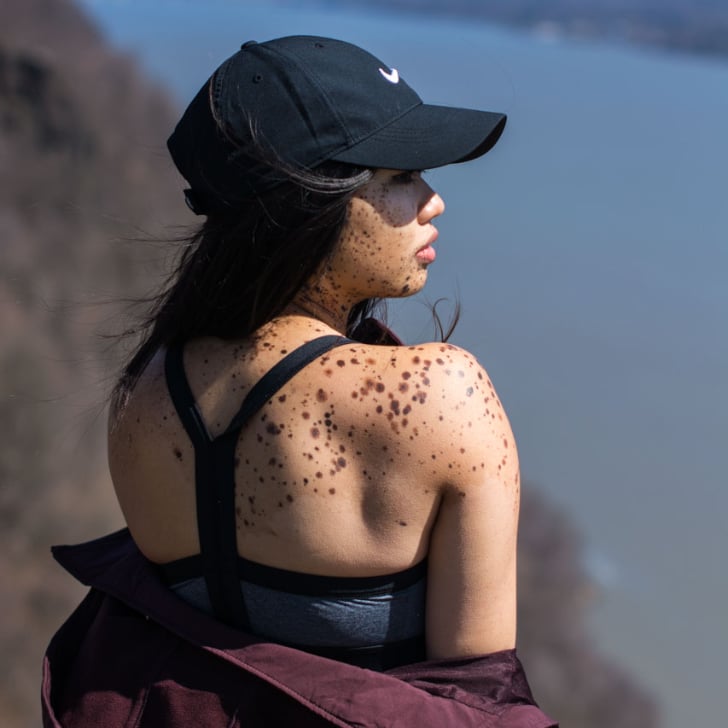 Living With a Skin Condition