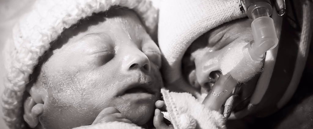Photo of Twin Who Died From TTTS
