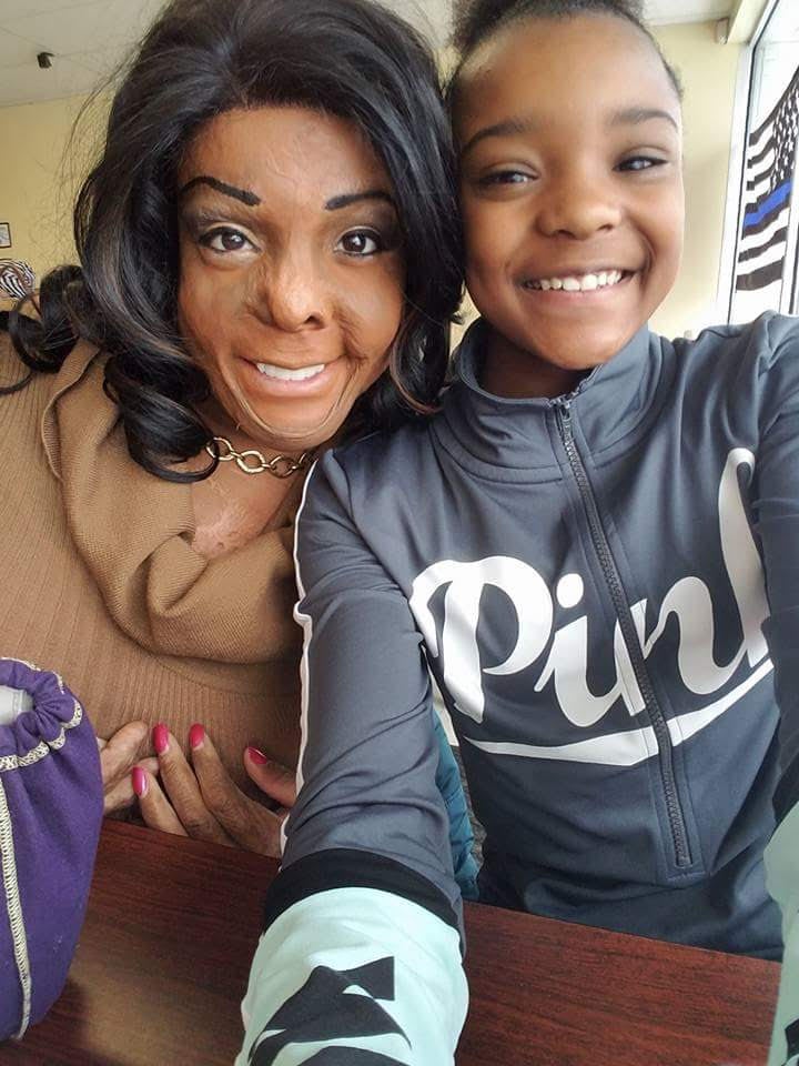 Burn Survivor Breastfeeding POPSUGAR Family