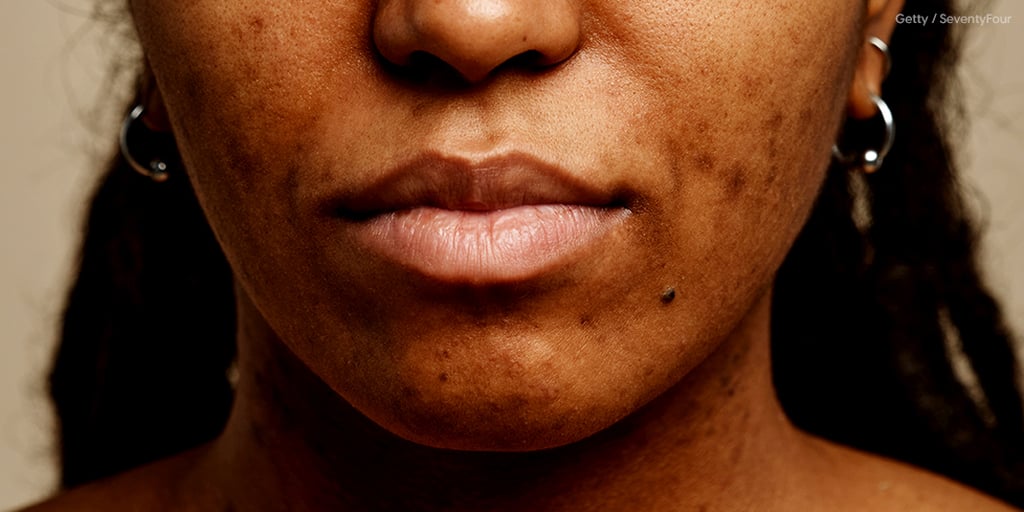 Hormonal Acne Causes and Treatments POPSUGAR Beauty