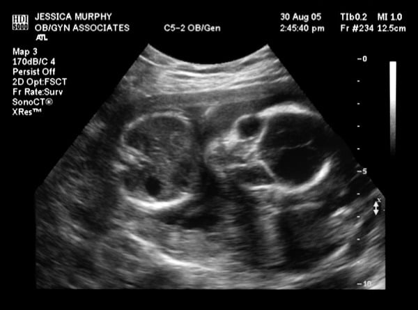 Omg My Baby Looks Like An Alien 12 Things We Re Really Thinking About During Our Ultrasounds Popsugar Family Photo 4