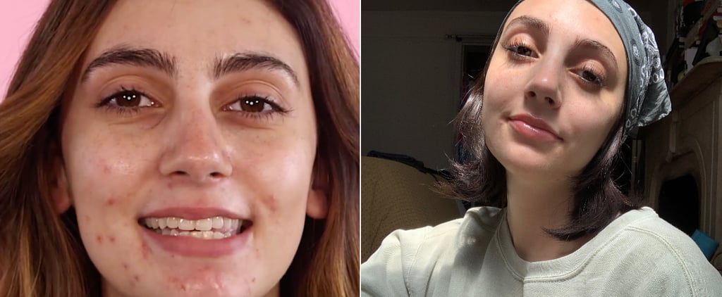 Personal Essay About Hormonal Acne During COVID-19