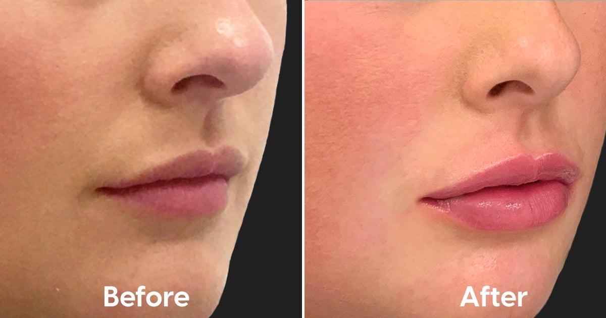 Correct Lip Filler Healing Process With Photos POPSUGAR Beauty UK