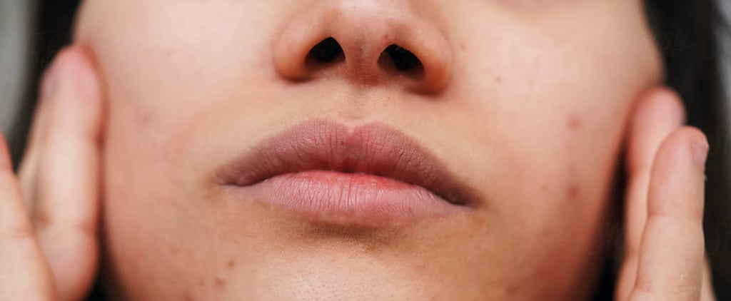 How to Remove Blackheads At Home, According to a Facialist