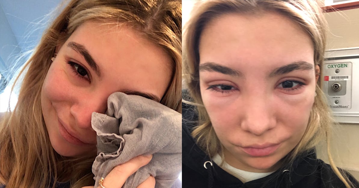 Allergic Reaction to Eyelash Tint Treatment POPSUGAR Beauty