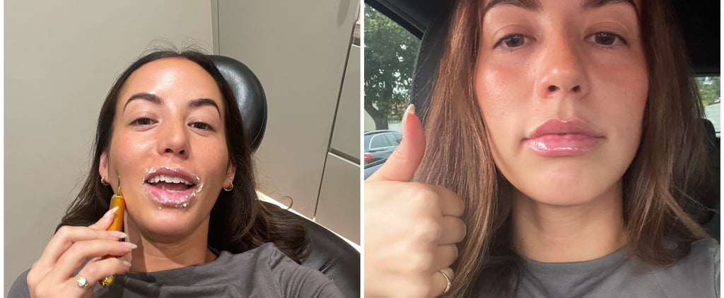 I Tried "Lip Gloss" Filler: See Photos