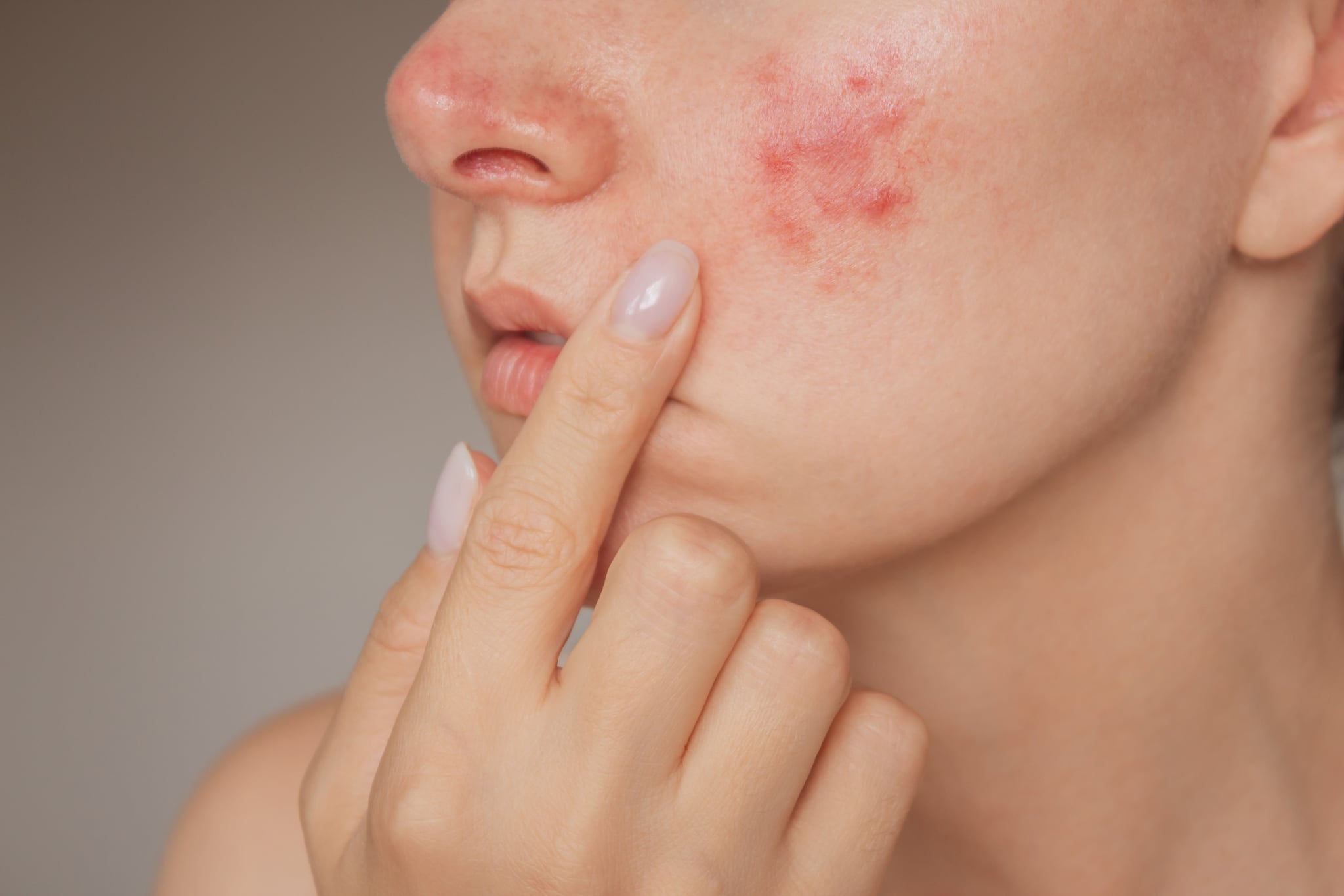 close-up photo of a young Caucasian woman suffering from the skin chronic disease rosacea on her face in the acute stage. Pink acne. Dermatological problems.  isolated on a beige background