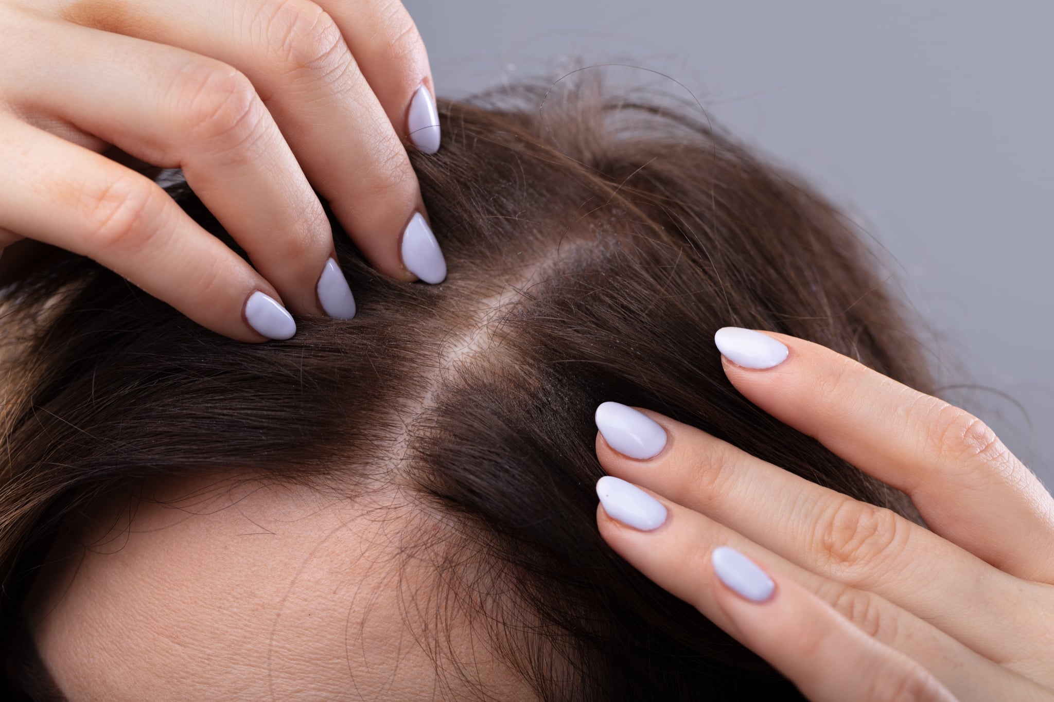 scalp psoriasis vs dandruff 