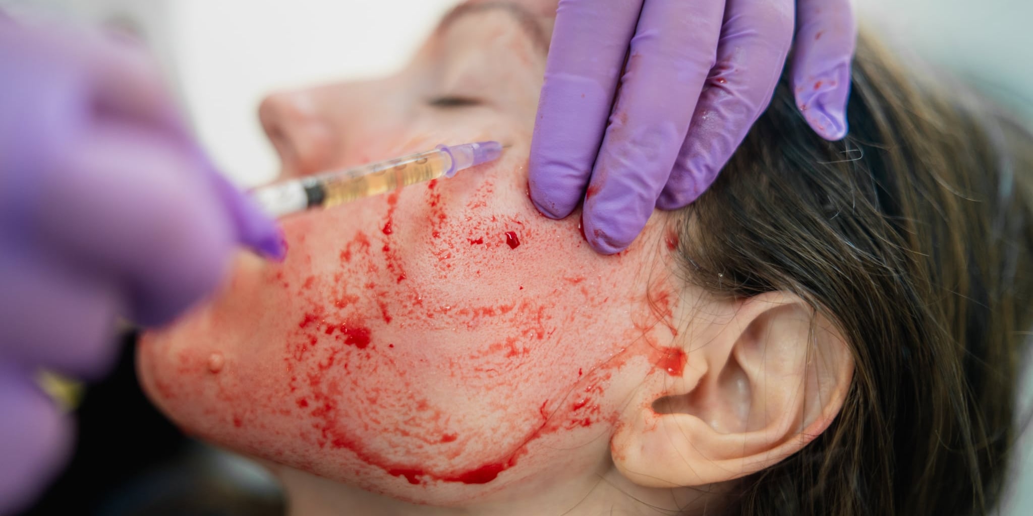 Vampire Facial Dangers | POPSUGAR Beauty - Vimarsana News