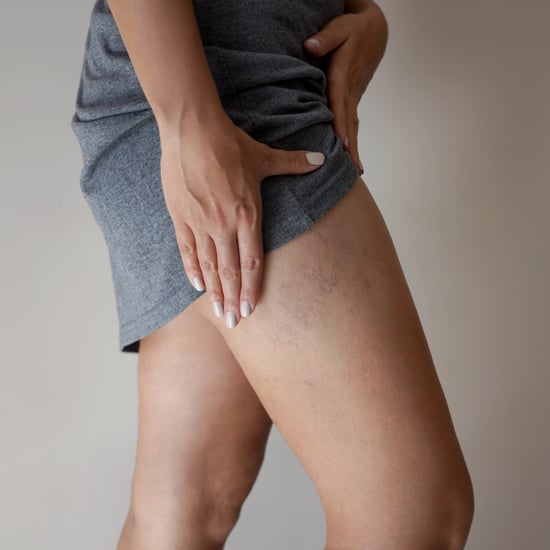 Preventing and Treating Spider Veins, According to Doctors
