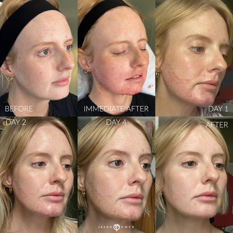 Progress photos after doing the Ellacore skin-tightening treatment