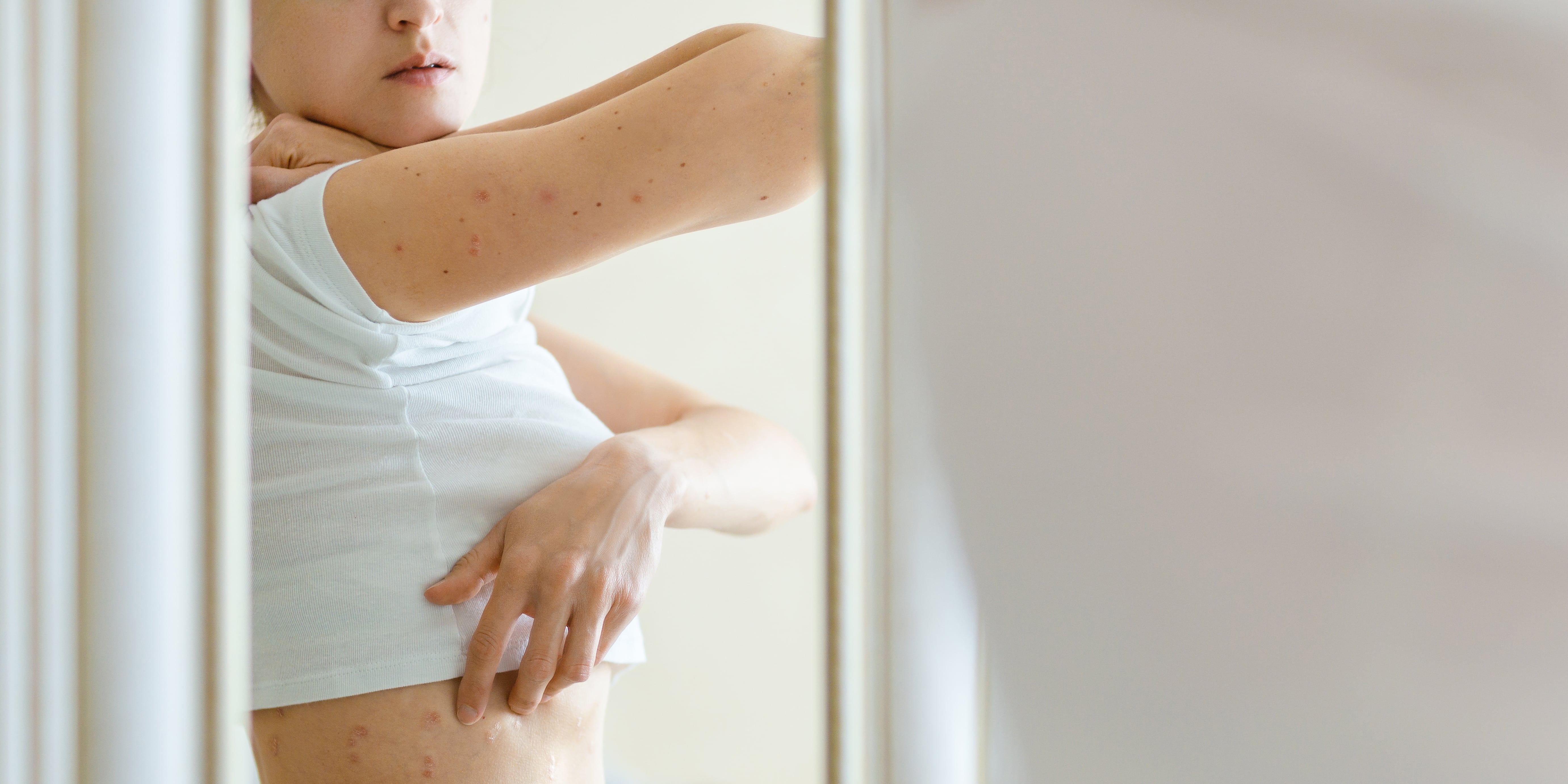 The Surprising Link Between Eczema and Eating Disorders — and What to Do